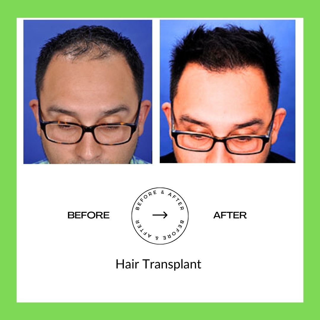 Hair Trasplant Surgery