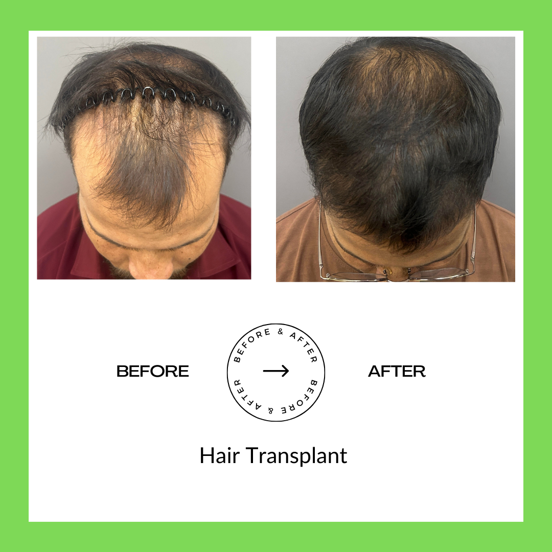 Hair Trasplant Surgery