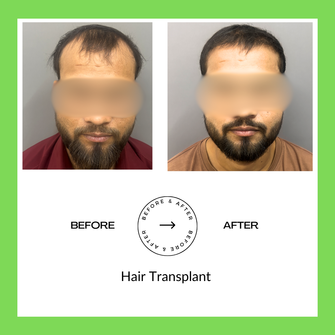Hair Trasplant Surgery